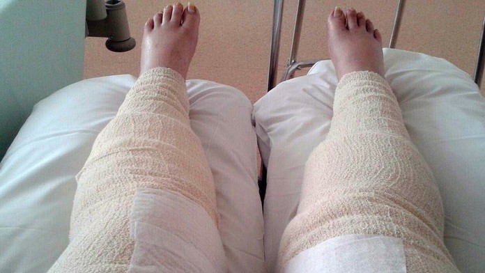 Šokujúci prípad. Oholila sa v oblasti bikín a takmer prišla o nohy