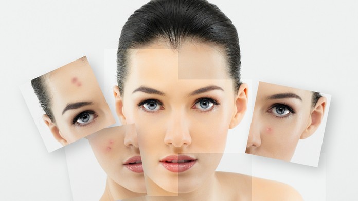 Akné - ilustračná snímka