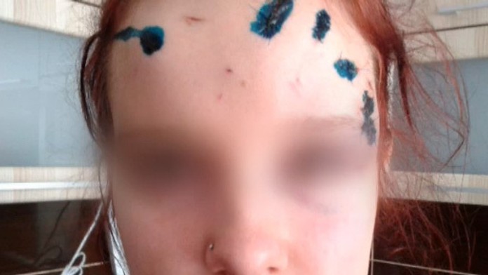 Muž znetvoril tvár dievčaťu