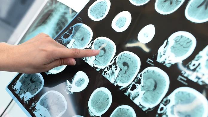 Vedci opísali neobvyklý prejav zákernej choroby. Pacienta (80) desí málo známe déjà vécu