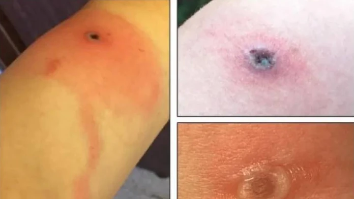 Nové vírusové ochorenie má prvú obeť. Všetko sa zrejme začalo škrabancom od mačky