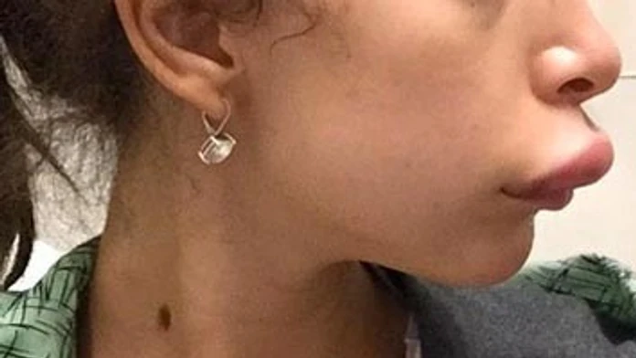 pery opuchnute.jpg