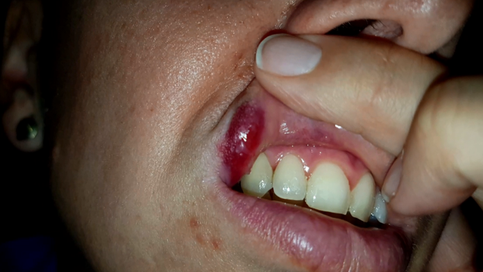 Žena dostala brutálnu ranu päsťou.