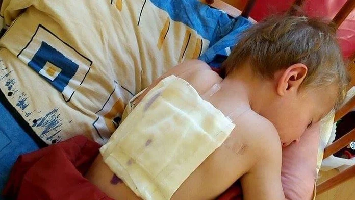Dieťa má na chrbte odreniny a popáleniny