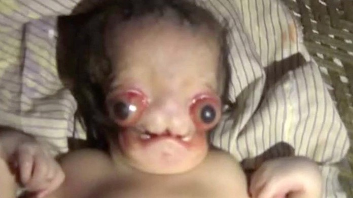 V Indii sa narodilo bábätko, ktoré sa podobá na mimozemšťana.