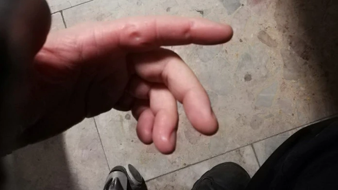 Uhryznutá ruka policajta.