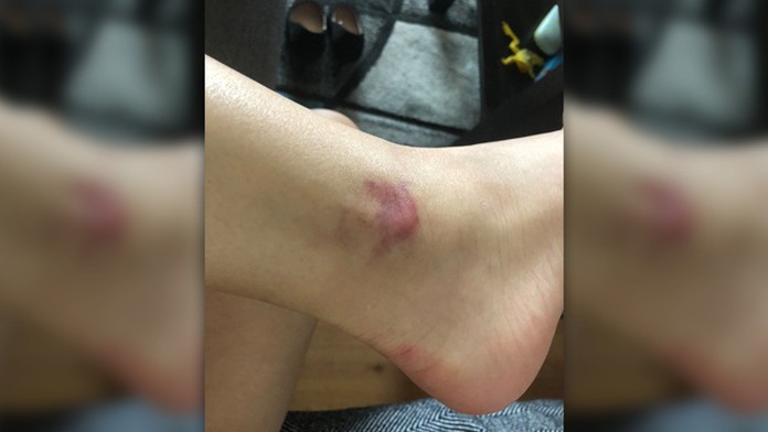 Uštipnutie komárom.