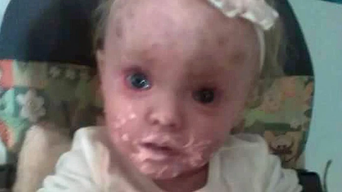 Paige Milby má genetickú chorobu.