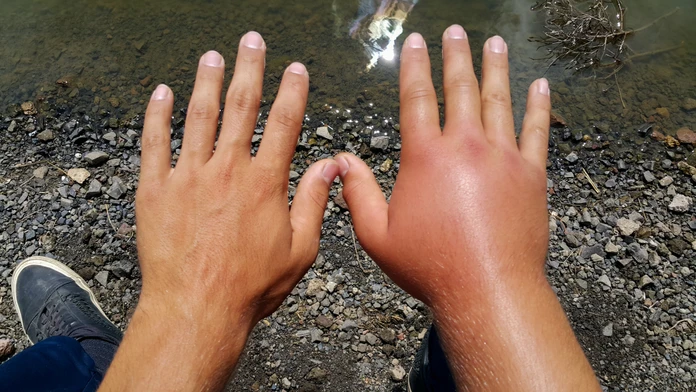 Alergikom svitá na lepšie časy. Utrpenia ich zbaví liečba, ktorá je dostupná už aj na Slovensku