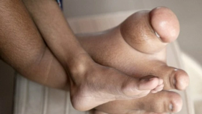 25FE08EC00000578-2965272-Verdant_s_father_Dilip_said_he_is_terrified_his_son_s_foot_will_-a-6_1424720828048.jpg