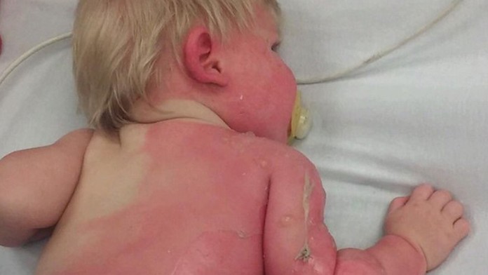 Chlapček utrpel popáleniny na 30-percentách tela.