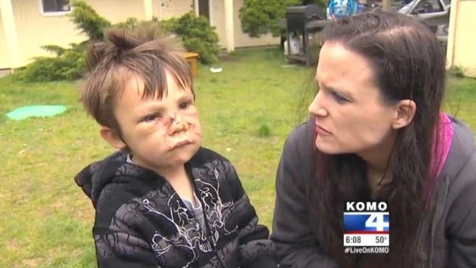 Gavina Tobecka napadol pitbul. 