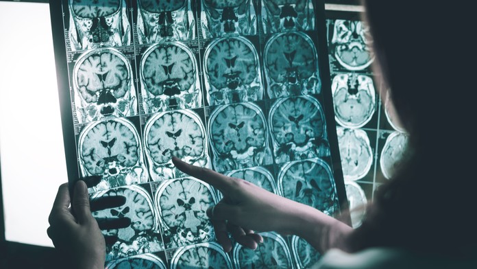 Nádej pre nespočetné množstvo ľudí. Lekári našli nový spôsob včasného odhalenia Alzheimera