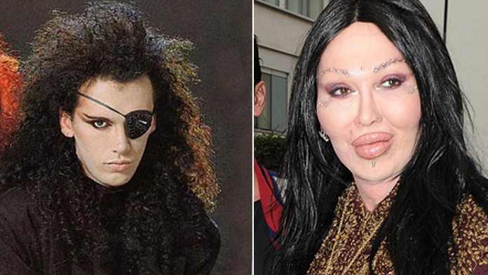 Zabilo ho 300 plastík? Kedysi pekný spevák skončil ako Frankenstein