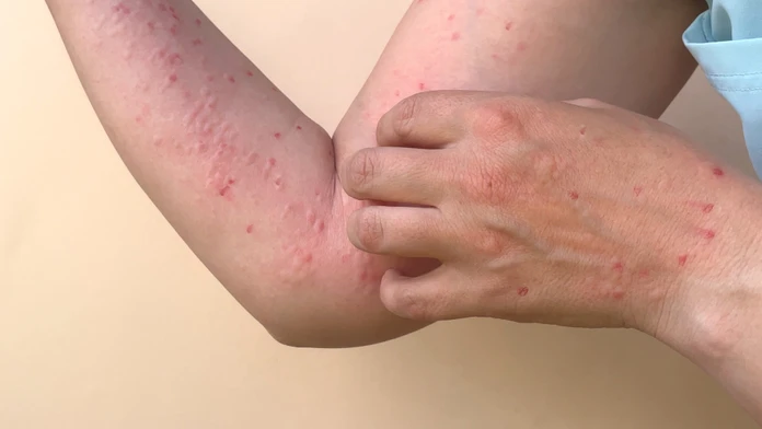 Belgicko hlási prvú obeť opičích kiahní. Tu sú podrobnosti