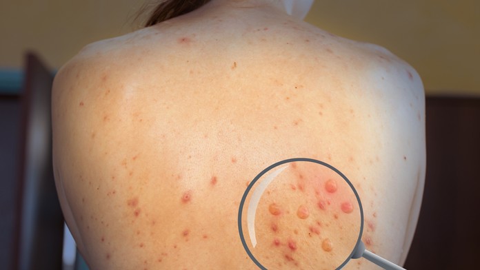 Mapa opičích kiahní vo svete. Pozrite sa, kde sú najväčšie ohniská