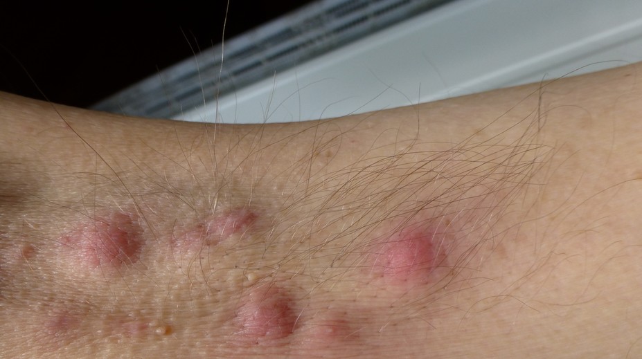 Neliečiteľné ochorenie kože trápi každého stého človeka. Vedci prišli na zaujímavú súvislosť