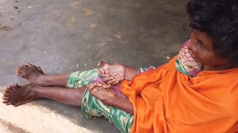 Žena trpí vzácnou anomáliou. Nadmerný počet prstov z nej robí rekordérku