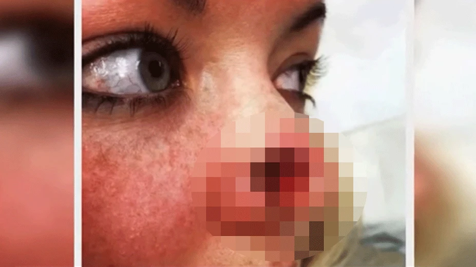 Žene po pravidelnej návšteve solária zostala v nose diera. Zistili jej rakovinu