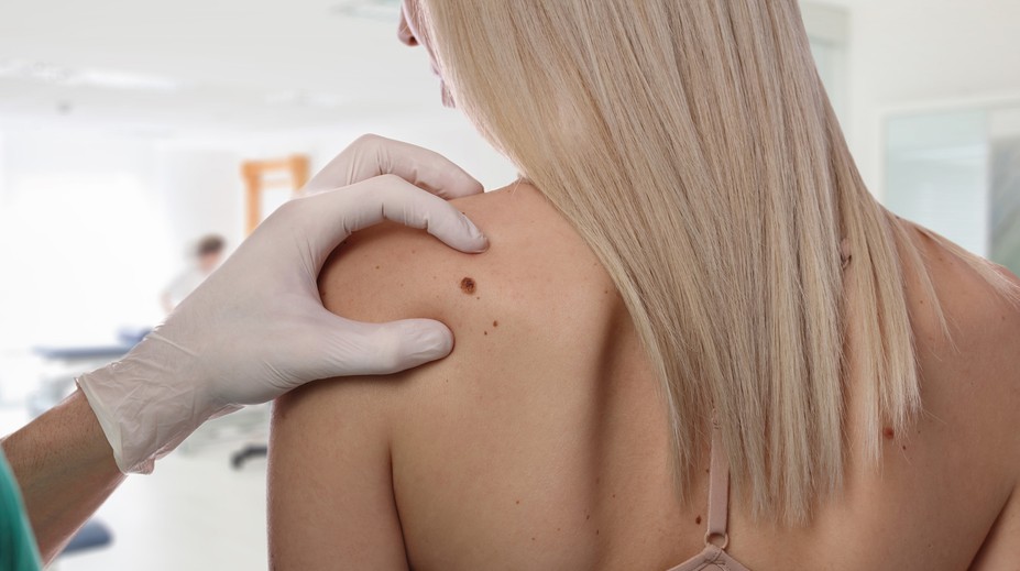 Máte nebezpečné znamienko? Zistíte to podľa rýchleho testu