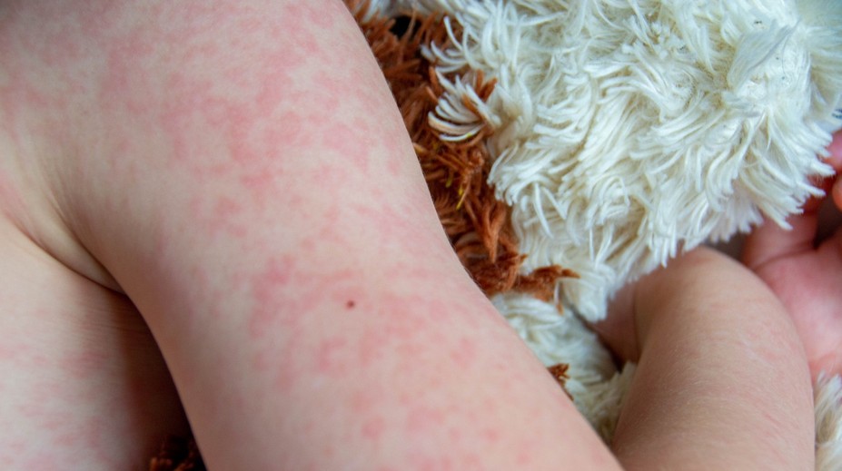 Osýpky nie sú banálne ochorenie. Pre jednu skupinu pacientov môže byť fatálne