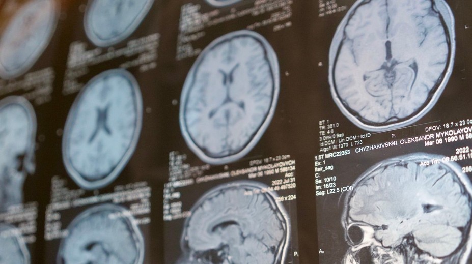 Vedci tvrdia, že vedia, prečo ľudia so schizofréniou „počujú hlasy“