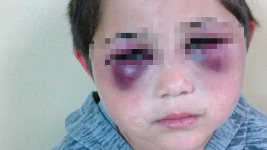 Podliatiny okolo očí a modriny na tele. Dobitého Ivanka (8) našli v zúboženom stave