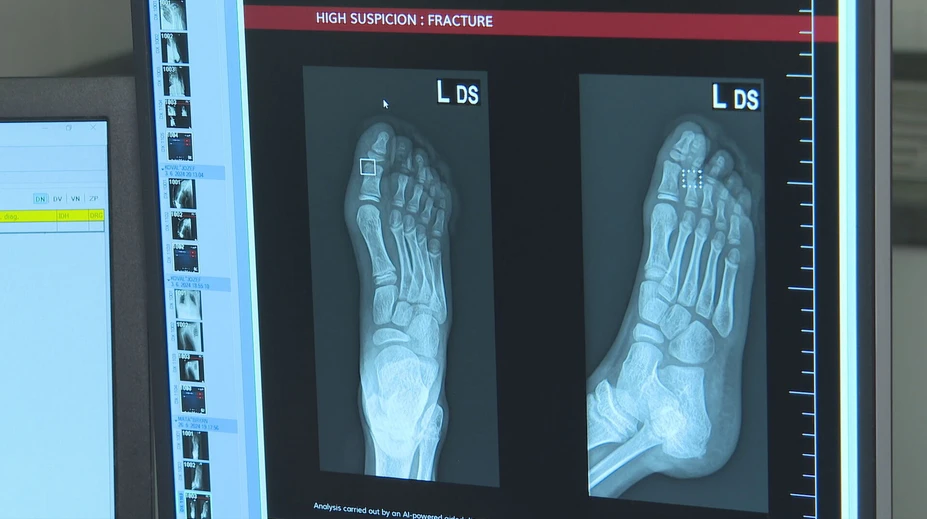 Košickí lekári na urgente využívajú umelú inteligenciu. Dokáže zbadať aj tie najmenšie zlomeniny