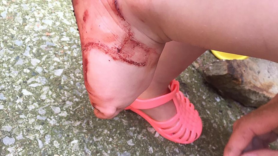 Sandále dievčatku hrozivo poranili nohy. Dostupné sú aj na Slovensku!