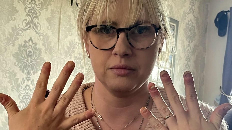 Žena roky nosila gélové nechty, teraz to horko ľutuje. Znetvorené prsty už takmer nedokáže ohnúť