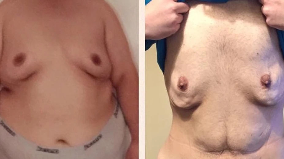 Neuveriteľná premena 200-kilového chlapa. Pozrite, ako vyzerá dnes