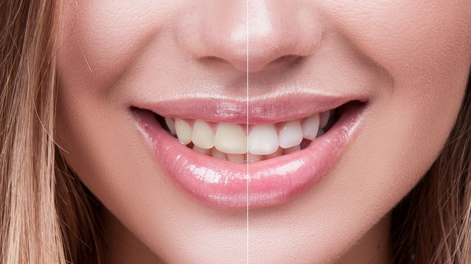 Žltnú vám zuby? Dávajte si pozor na tieto jedlá, nápoje a činnosti