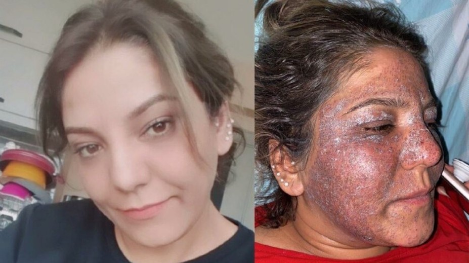 Túžila po vyhladení vrások, po zvláštnom zákroku však skončila s hnisom a opuchmi na tvári