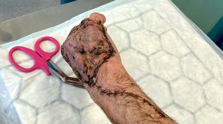 Z drobného škrabanca sa stala vážna infekcia. Mužovi zmenila ruku na nepoznanie