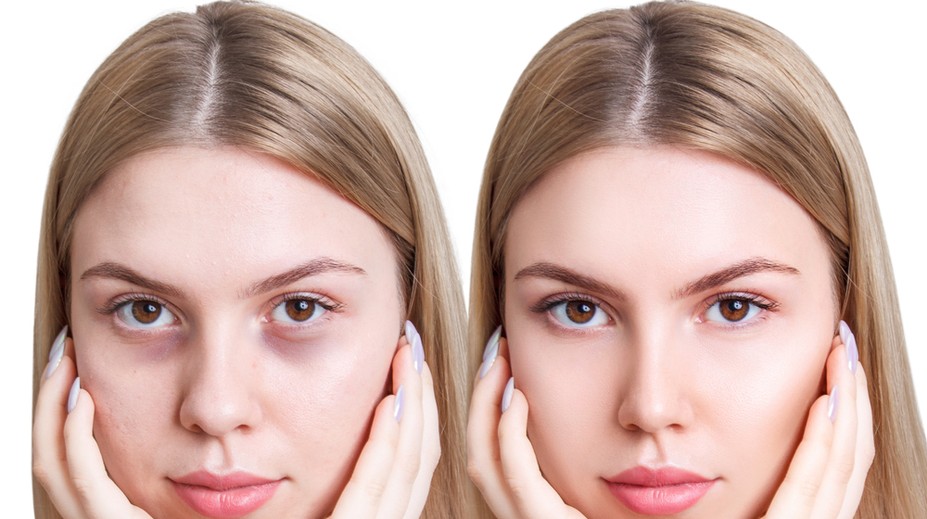 Trápia vás kruhy pod očami? Takto s nimi zatočíte