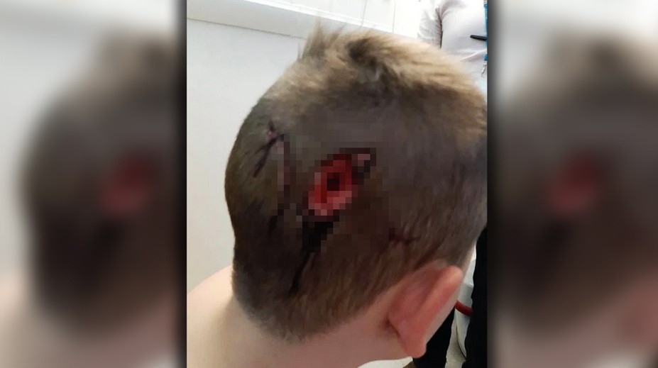 Brutálny útok psov. Chlapec (8) skončil s poranenou lebkou a hlbokou ranou