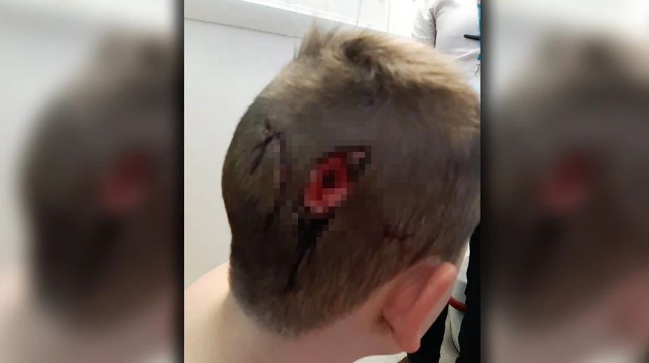 Brutálny útok psov. Chlapec (8) skončil s poranenou lebkou a hlbokou ranou