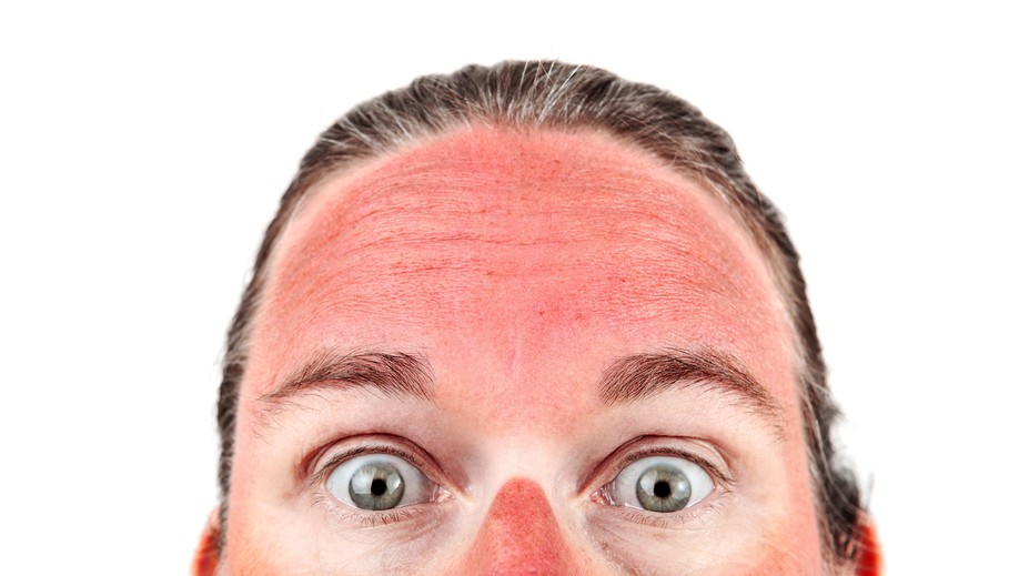 Pozor na zákerné slnko. Môže spôsobiť mnoho ťažkostí