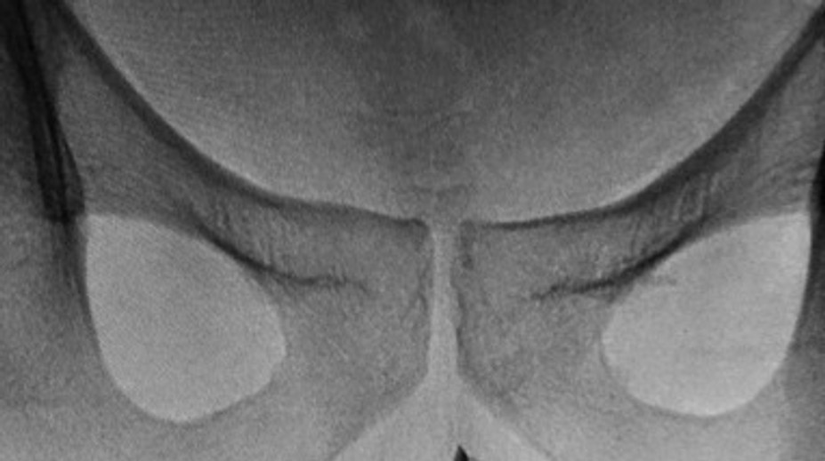 Mladík (22) mal štyri roky v penise netypický predmet. Necítil vraj žiadnu bolesť