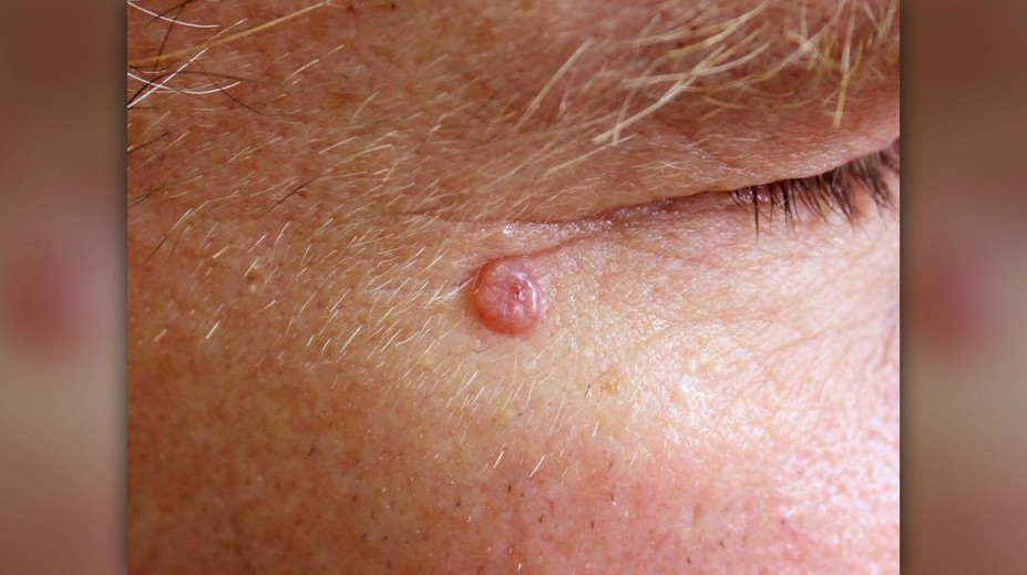 Máte malé škvrny na tvári? Nezanedbávajte vyšetrenie, doktor varuje pred stratou oka