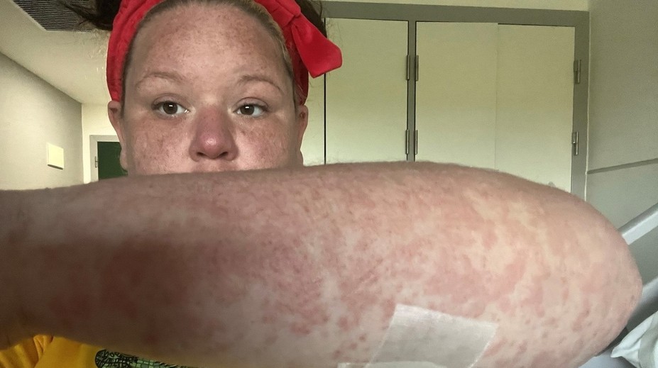 Ženu bodol na dovolenke nebezpečný hmyz. V reakcii s antibiotikami jej opadávali koža, vlasy aj nechty