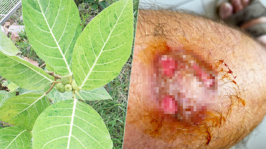 Vážne popáleniny mu spôsobila miazga zo známeho kríka. Pán Martin varuje aj ostatných záhradkárov