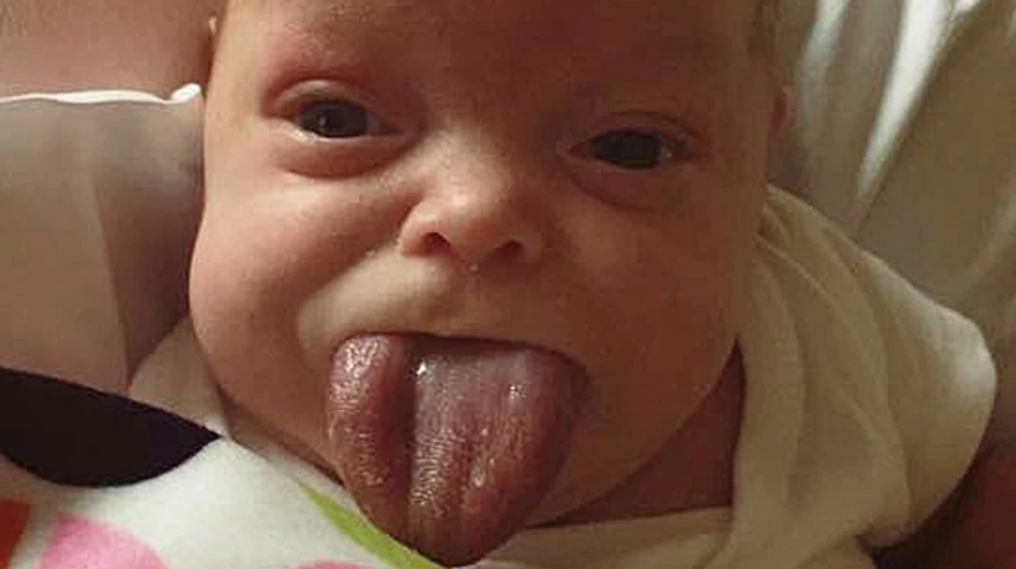 Dievčatko sa narodilo s obrovským jazykom. Teraz sa už konečne môže usmievať