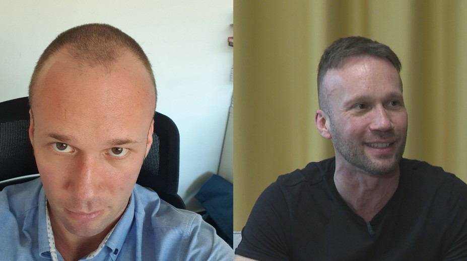Roman podstúpil vlasovú transplantáciu. Popísal, ako to celé prebiehalo