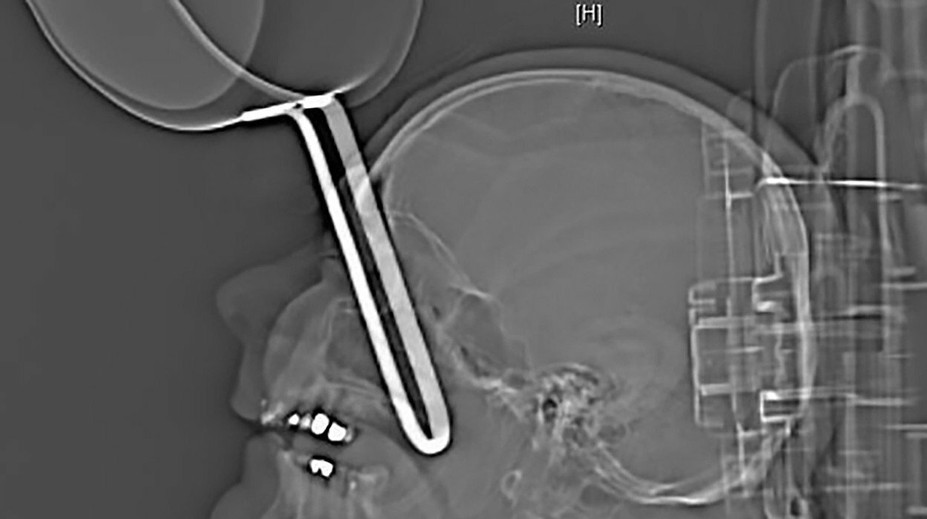 Lekári niečo podobné ešte nevideli: Opitý Nemec si vrazil panvicu do lebky