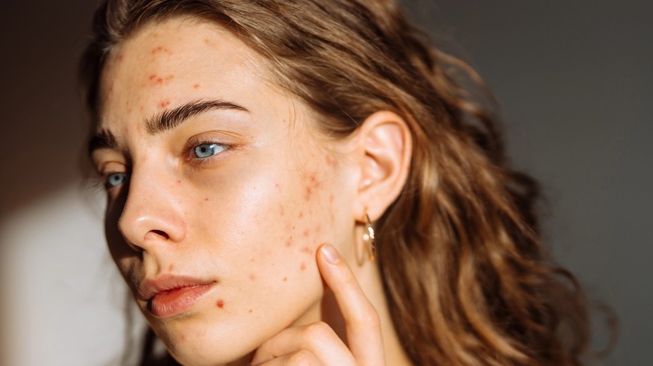 Šíri sa návod, ako sa zázračne zbavíte akné. Dermatologička vysvetľuje, prečo je to hrozný nápad