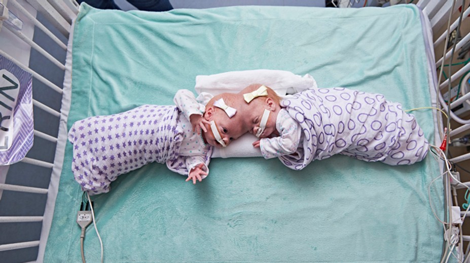 Vo Philadelphii oddelili desaťmesačné siamské dvojčatá. Spojené boli hlavami