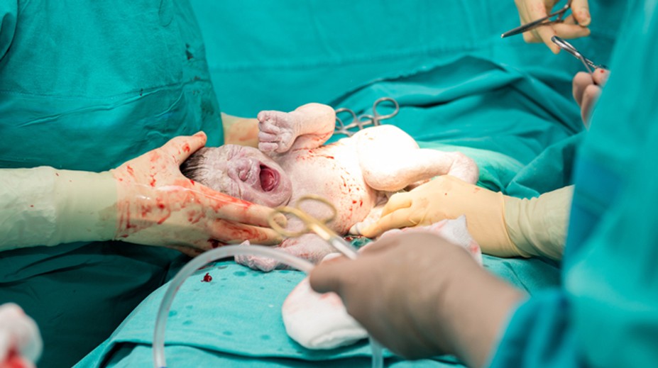 Je cisársky rez nebezpečný trend? Odborník to povedal natvrdo