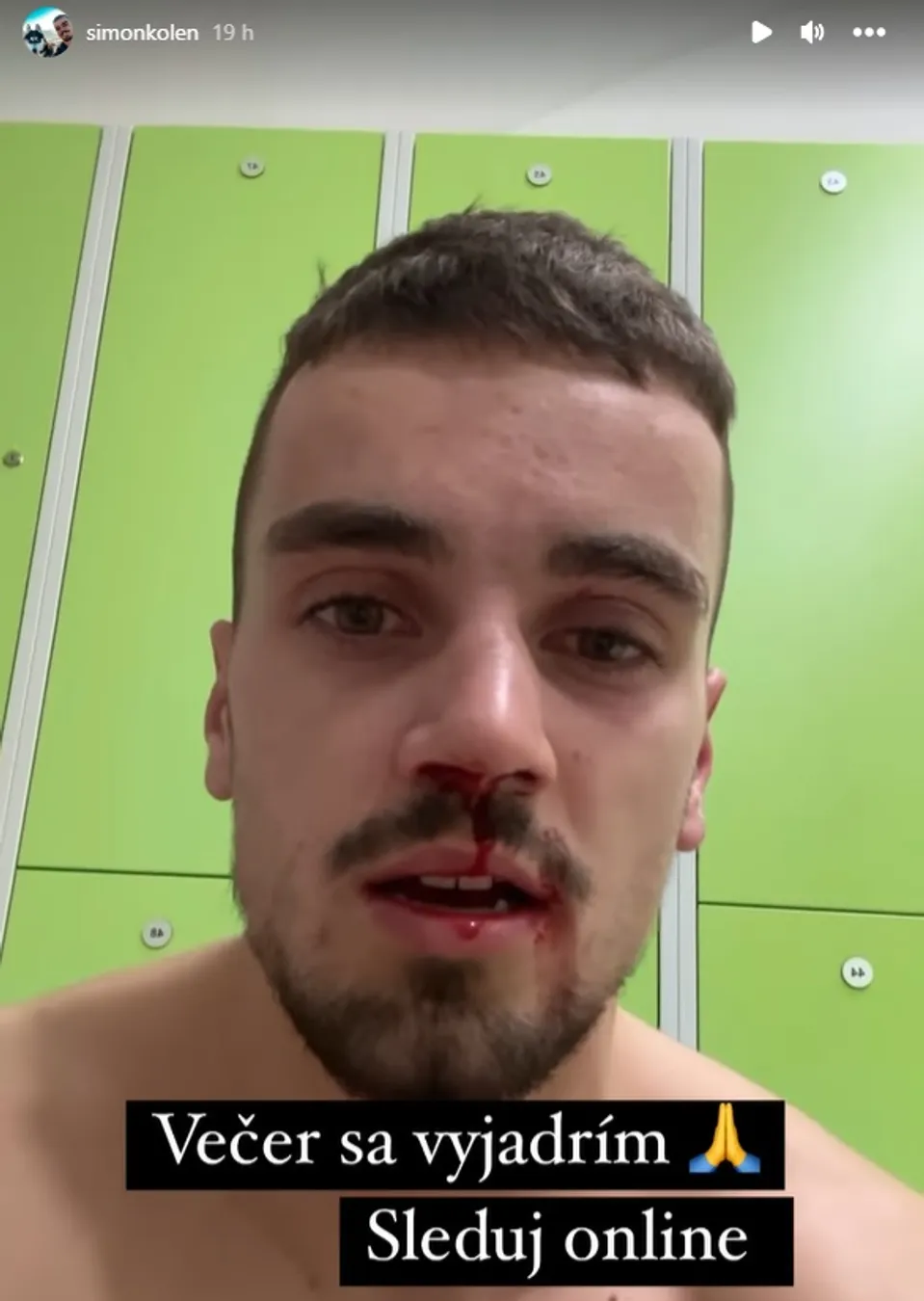 Farma - Šimon so zlomeným nosom