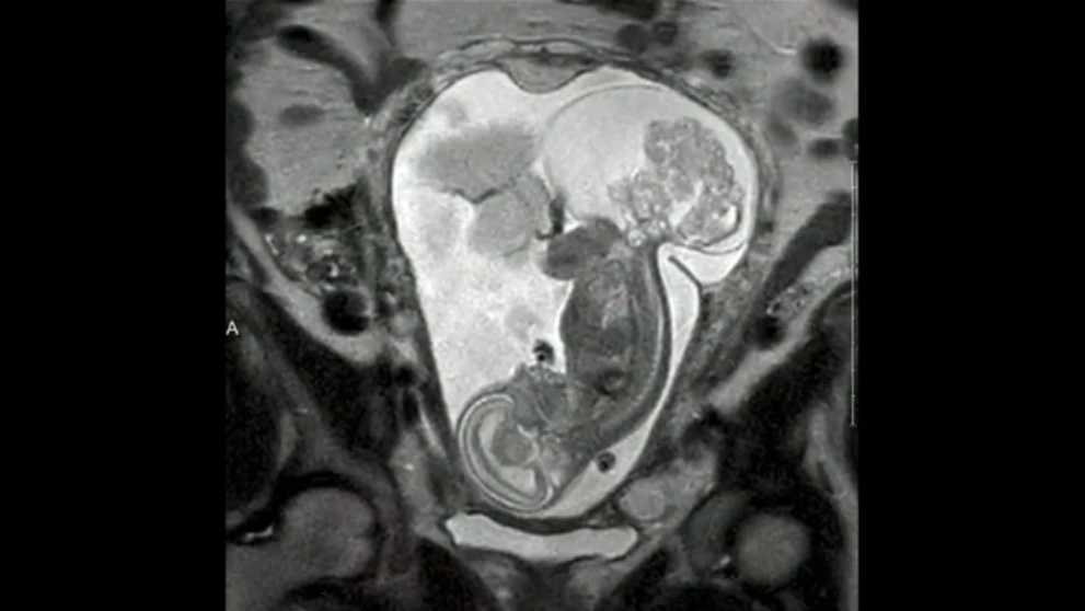 Dieťa a tumor